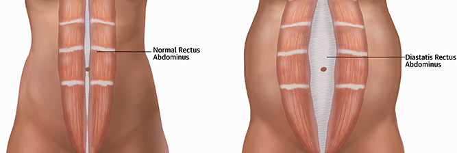 διάσταση κοιλιακών (diastasis recti)